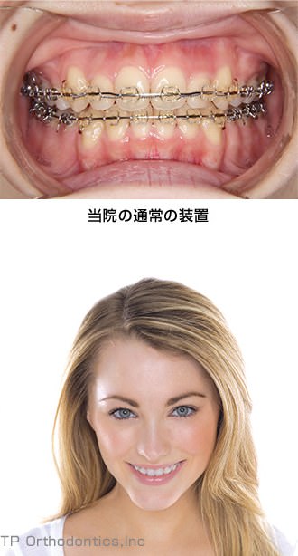 当院の通常の矯正装置を装着した歯列と、女性の口元