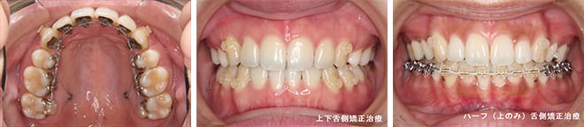 舌側矯正(裏側矯正)の症例。上顎裏側の装置、上下舌側矯正、ハーフ(上のみ)舌側矯正の比較
